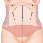 Lipoabdominoplastia HD – a evolução da abdominoplastia