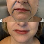 Lifting facial: plicatura do SMAS e platisma versus Deep Plane