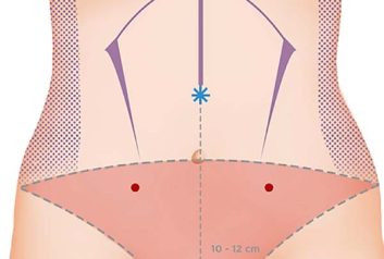 Lipoabdominoplatia-HD-1